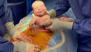 ولادة طبيعية بعد القيصرية