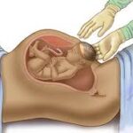 قبل الولادة القيصرية : نصائح طبية للحوامل