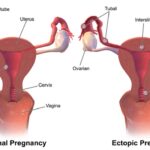 أعراض وأسباب الحمل في قناة فالوب
