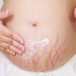نصائح لتجنب ترهل الجلد بعد الولادة