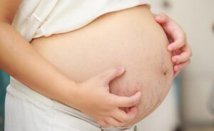 تغيرات جلدية أثناء الحمل