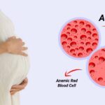كيف تعرف المرأة الحامل أنها مصابة بفقر الدم؟