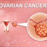 سرطان المبيض| Ovarian Cancer